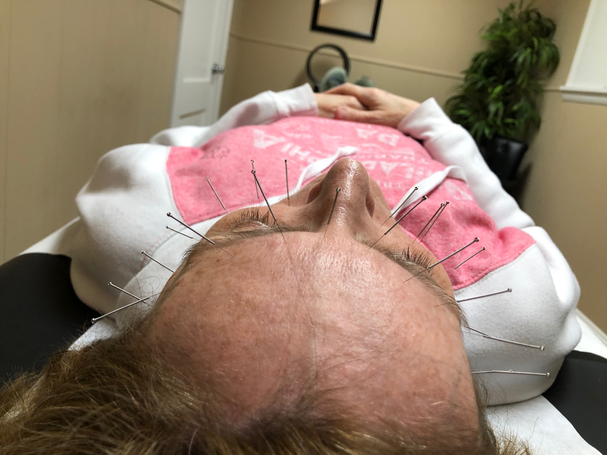 Dry Needling and Sinus Problems